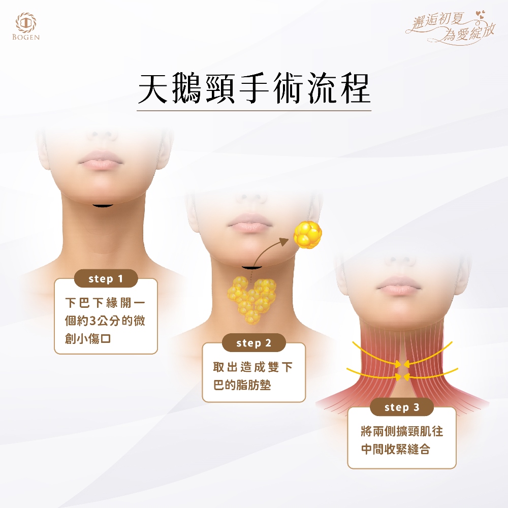 天鵝頸手術流程,天鵝頸手術過程,天鵝頸手術,博恩妍